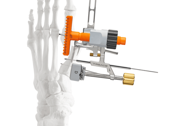 Medical device attached to a skeletal foot for orthopedic treatment on a clear background.