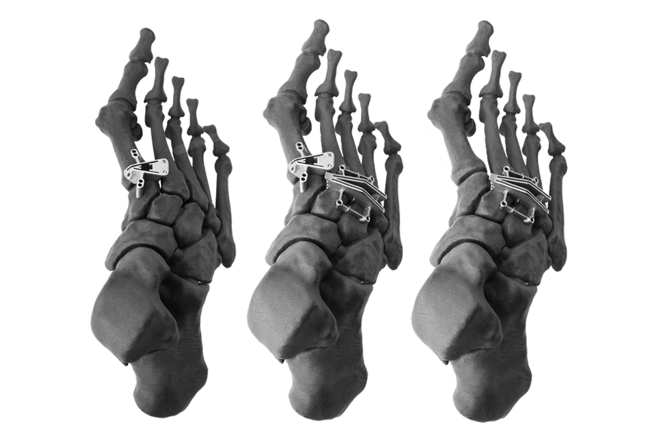 Three X-ray images showing human feet with surgical bone plates and screws for bone repair.
