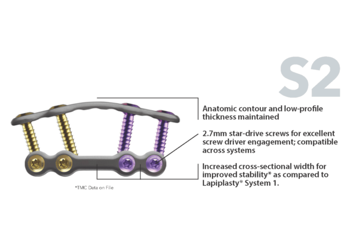 Surgical plate with screws showing anatomic contour and stability for Lapiplasty System 1, highlighting screw drive compatibility.