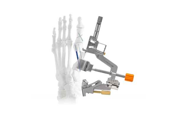 Skeleton of a foot showing a mechanical device attached to it, illustrating medical equipment or procedure.