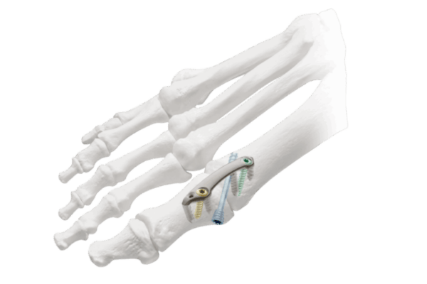 Diagram of a foot skeleton with surgical plate and screws on the metatarsals.