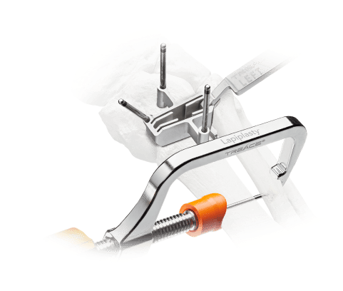 Surgical tool applied to a bone model showcasing precise medical equipment for orthopedic procedures.