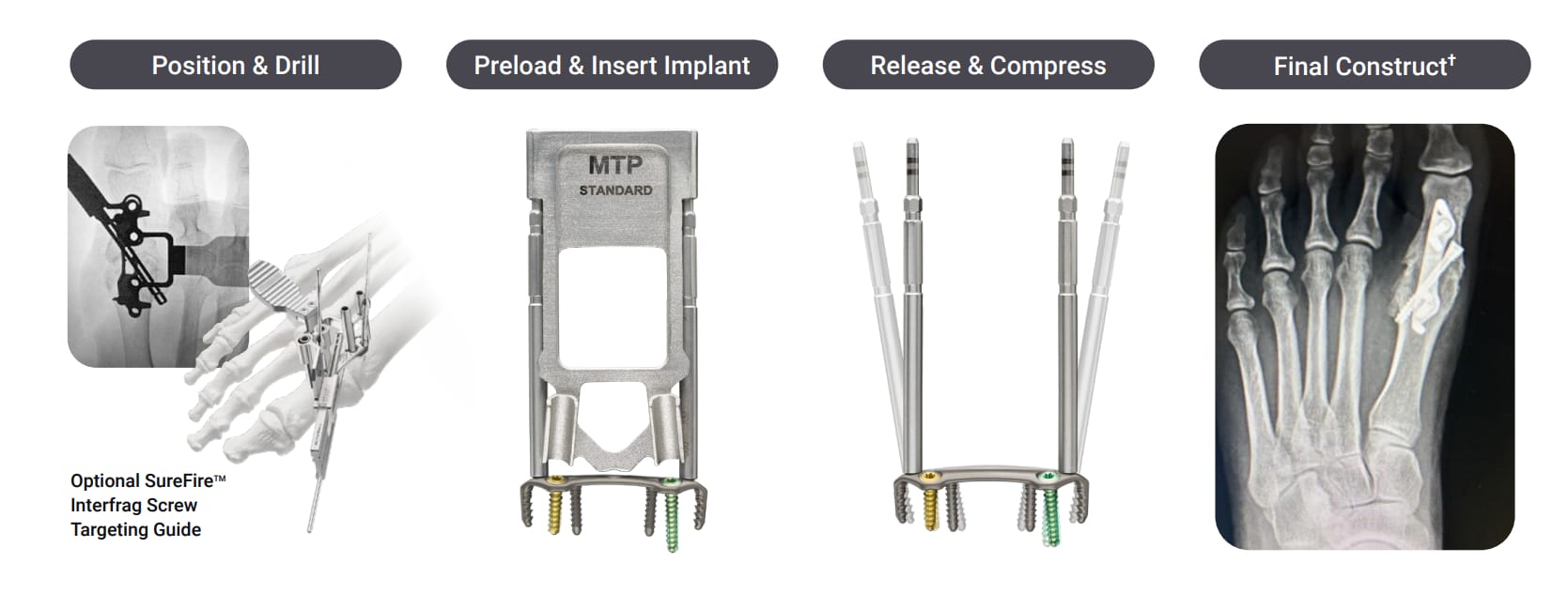 MTP-3000 　moisteane pro SpeedMTP® | Rapid Compression for First MTP Fusion